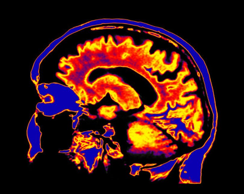 Image shows an illuminated brain scan